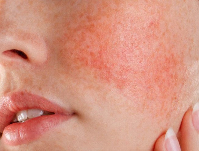 Skincare Guide to Managing Rosacea