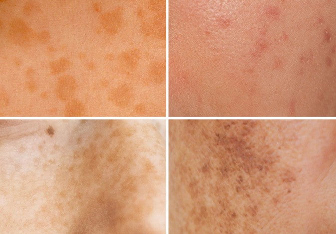 Expert Tips for Managing Hyperpigmentation